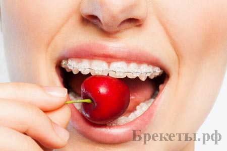 лечение брекетами