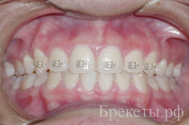 фото до и после в ортодонтии